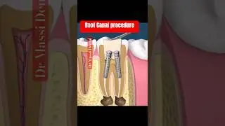ROOT Canal Procedure on Molar