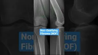 Non-Ossifying Fibroma 