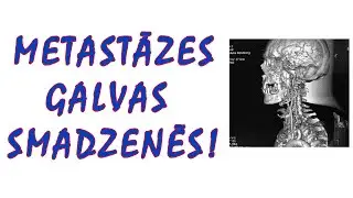 Kas ir pats izplatītākais audzējs smadzenēs?  Metastāzes!