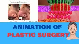 Plastic Surgery 3D Animation - Bruce RoBinSon | Austin Visuals