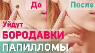 Как избавиться от бородавок и папиллом НАВСЕГДА | Средство 💯% эффект!