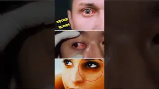 জেনে নিন! ভয়ঙ্কর এই রোগের সমাধান 😳 