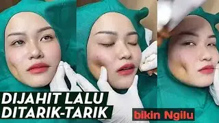 Viral video pembuatan lesung pipi,bikin ngilu