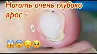 Ноготь🦶🏻который очень глубоко врос😨😱