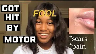 Got Hit By A Motorcycle; STORYTIME. | reason for my scars | funny |