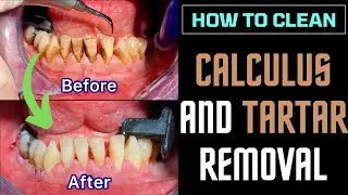DENTAL CALCULUS and TARTAR removal - TARTRECTOMY before and after DENTAL CLEANING