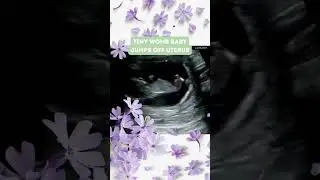 Womb Baby Jumps Off Uterus! 😇🫢#shorts