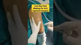 Live Key Hole Making For ACL Ligament Surgery | 