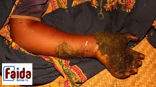 MTOTO WA MIAKA 5 ACHOMWA MOTO VIGANJA VYAKE NA MAMAAKE MZAZI AKIDAIWA KUIBA SH 250 MTWARA.