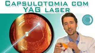Capsulotomia com YAG laser - Limpeza da lente intraocular.