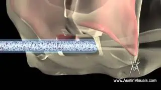 3D Medical Animation - Surgical Dental Procedure