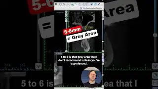 Indirect Sinus Lift Height   