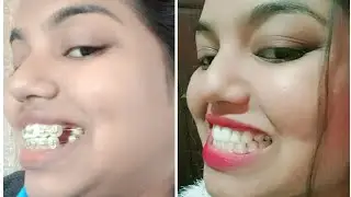 MY BRACES JOURNEY MONTHS / Braces Journey transformation