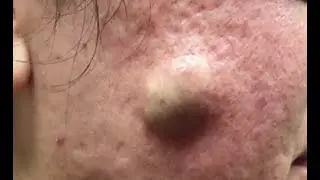 Remoção de cravo 2021 - Pimple Popping 2021- Blackhead Removal 008