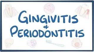 Gingivitis and periodontitis - causes, symptoms, diagnosis, treatment, pathology
