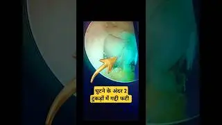 Meniscus Broken in 2 Part 💥 घुटने की गद्दी मेनिस्कस गई काम से 