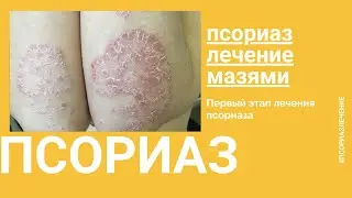 Псориаз лечение. Псориаз лечение мазями. Первый этап лечения псориаза.