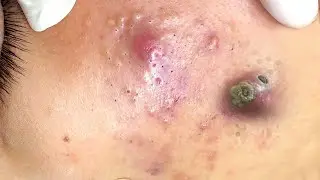 Удаление черных точек 2021 - Remoção de cravo 2021 - Pimple Popping 2021 -Blackhead Removal 2021