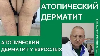 Атопический дерматит. Атопический дерматит лечение. Часть 2.