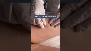 Поэтапное видео лазерной эпиляции 