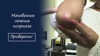 Мгновенное лечение псориаза! Проверено #лечениепсориаза #псориаз  #75