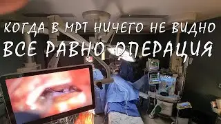 Невралгия тройничного нерва котороя вызвана прямым контактом между нервом и кровеносным сосудом