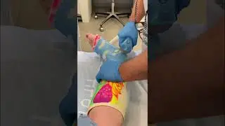 Taking my cast off… Hello LEG