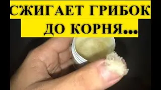 Эта ЯДРЕНАЯ Мазь, Съедает Ногтевой Грибок До Самого Корня! Есть в Любой Аптеке..