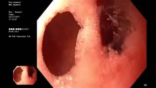 Deformation and scarring of the duodenal bulb. Diverticulous form.