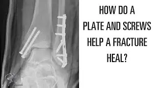 How does a plate and screws help a broken bone heal?