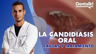 ¿HONGOS en la BOCA? Causas, prevención y tratamiento de la CANDIDIASIS oral y BOQUERAS | Dentalk! ©
