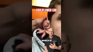 Dead Cartilage or Mark of Distinction⁉️ Cauliflower Ear 