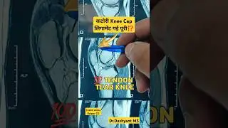 अब घुटना नही होगा सीधा ⁉️ Knee Cap Patella  Ligament 💯 Tear | 