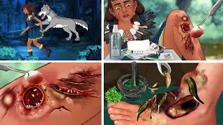 ASMR Treatment infected wounds and removes maggots from Aboriginal girl's feet - 늑대에게 물린 상처 치료