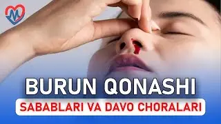 Burun qonashining sabablari va davo choralari