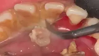 Tartar removal