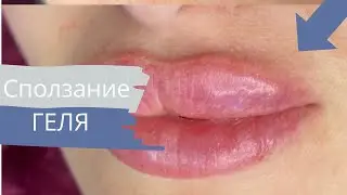 5 ПРИЗНАКОВ Миграции ГК / Бортик над губой / Белые точки после филлера / Шарики  