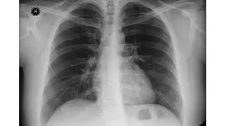 chest x-ray - Idiopathic Pulmonary Fibrosis