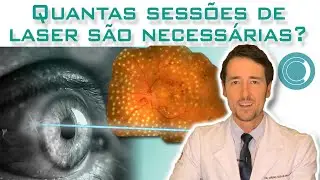 Quantas sessões de fotocoagulação a laser para retina são necessárias?