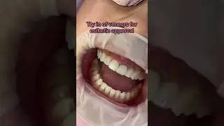 Smile makeover with just 6 veneers! 