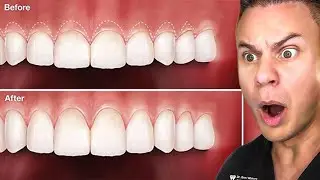If You Have A GUMMY Smile, Watch This!