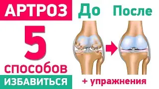 5 способов для здоровья суставов при артрозе
