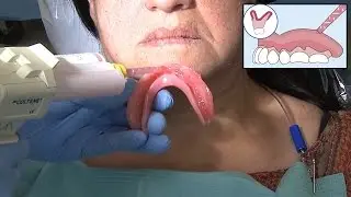 Clinical Demonstration: Zest Chairside Soft Reline After Implant Placement