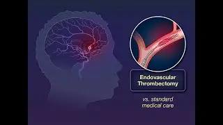 Endovascular Thrombectomy for Large Ischemic Strokes | NEJM