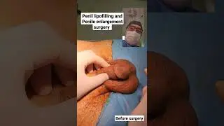 Penil lipofilling and Penile enlargement surgery before surgery Dr Araz Bayramov 