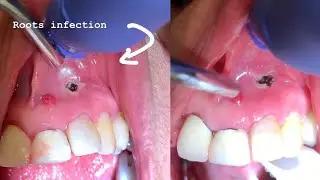 Worm 🐛 Holes in the mouth