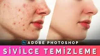 PHOTOSHOP SİVİLCE TEMİZLEME | Cilt Temizleme | Photoshop Acne Removal