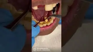 Dental Tartar, Calculus 