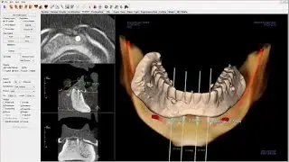 Zest LODI Guided Surgery Planning & Technique Guide by Robert Chen