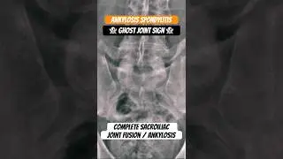 Ankylosing Spondylitis - Ghost Sign 